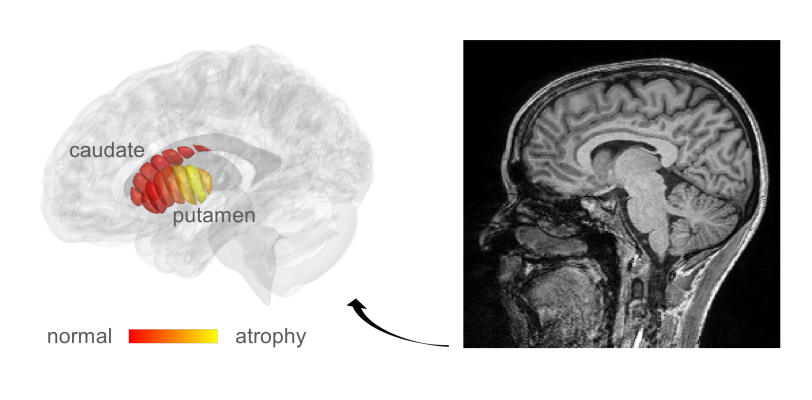 SWI, susceptibiltiy - Questions and Answers ​in MRI