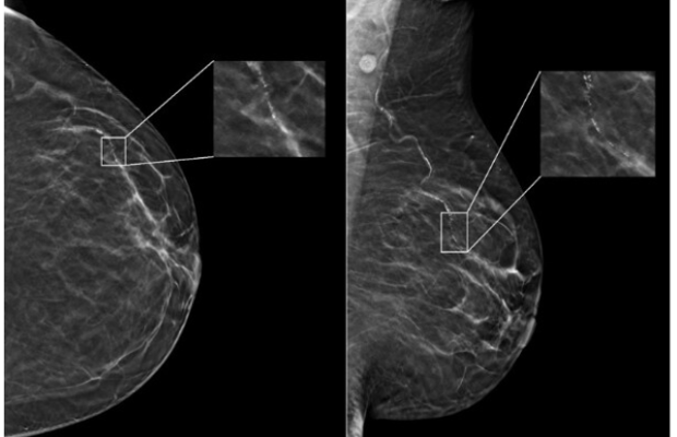According to a newly-published study of nearly 5,000 screening mammograms interpreted by an FDA-approved AI algorithm, patient characteristics such as race and age influenced false positive results. 