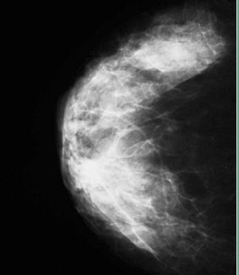 dense breast