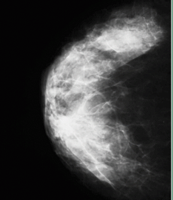 dense breast tissue