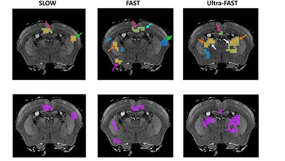 New MRI Technique Captures Brain Changes in Near-real Time