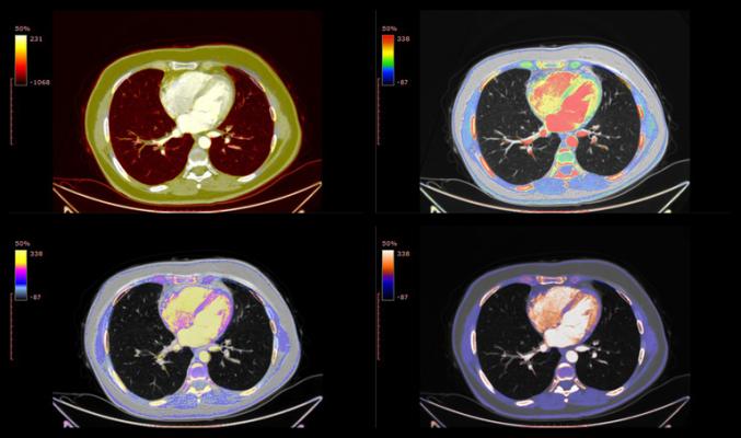 Most Persons Screened for Lung Cancer Meet USPSTF Criteria But