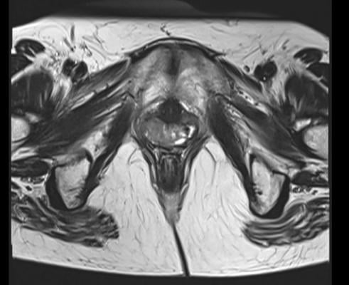 Sexual Activity and Vaginal Dilation Associated with Fewer Side