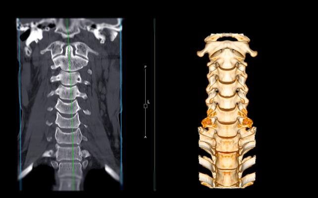 RSNA Launches Cervical Spine Fracture AI Challenge Imaging