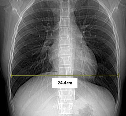 New Image Wisely Radiation Safety Case Available Optimizing Radiation Use During A Difficult Ivc Filter Retrieval Imaging Technology News