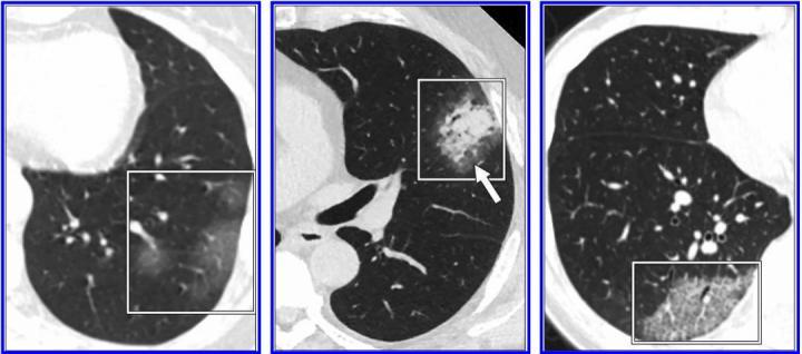 A Review Of Studies Cautions Against Chest Ct For Coronavirus Diagnosis Imaging Technology News