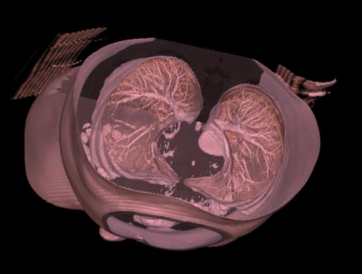 Minimal dose CT, chest X-Ray 