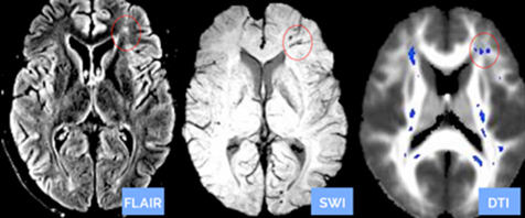 MRI systems, Clinical Trial/Study, Diffusion Tensor Imaging