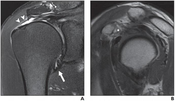 full thickness rotator cuff tear