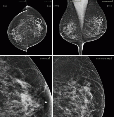 Ai Tool Improves Breast Cancer Detection On Mammography Imaging Technology News