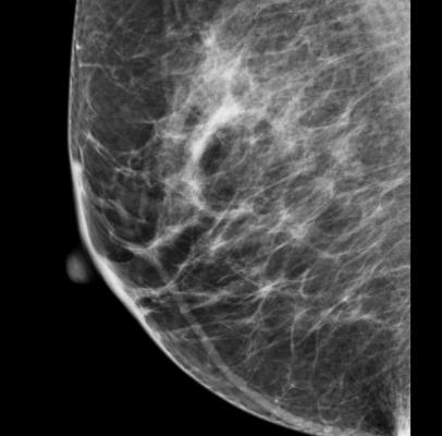 Mammography NHS Breast Screening Programme London United Kingdom