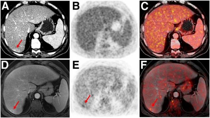 Hybrid PET Imaging: PET with MRI and CT