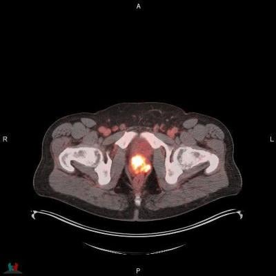 POSLUMA (flotufolastat F 18) PET/CT image showing uptake in the prostate gland, consistent with primary prostate cancer.