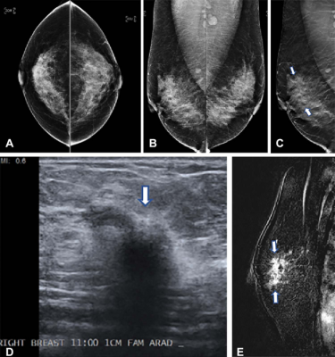 A‐D, Breast MRI, with bilateral multiple masses, two in the right