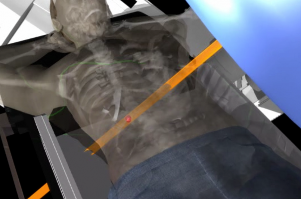 radiotherapy, patient reporting, side effects