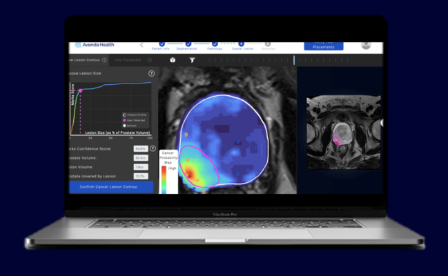 A new UCLA study found Unfold AI’s precise prediction of prostate margins significantly impacts the success of focal therapy treatments