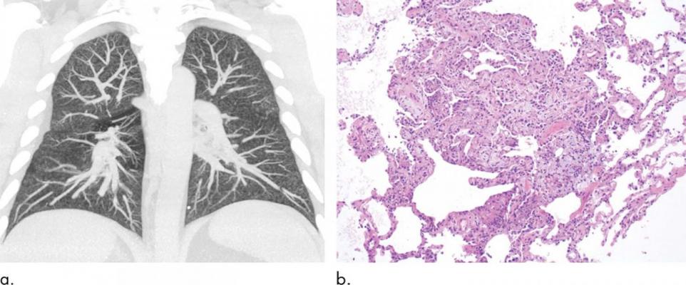 Abnormal Imaging Findings Key to EVALI Diagnosis in Vapers