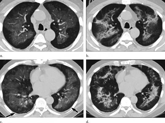 Lung Injuries from Vaping Have Characteristic Patterns on CT