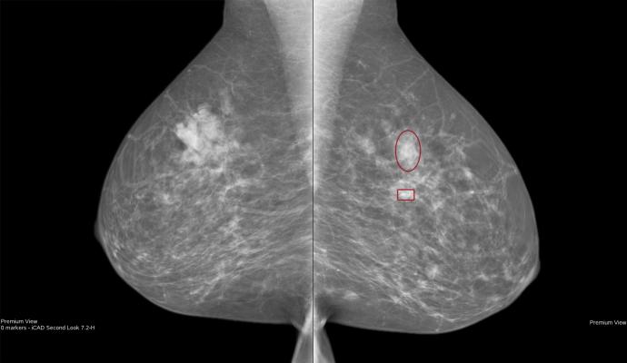 icad mammography