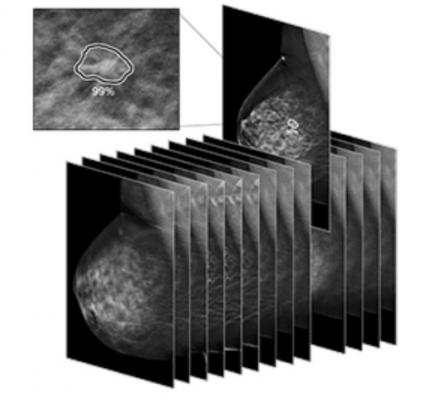 FDA Clears for ProFound AI Version 3.0 for 3D Mammography