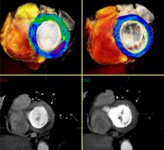 Toshiba CT Myocardial Perfusion Advanced Visualization CT Systems