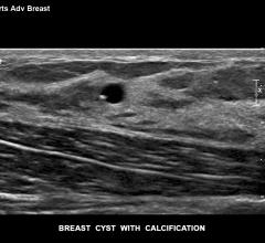 Philips Epiq ultrasound image of a breast cyst and calcifications. Breast ultrasound is often used as an augmentation of mammography in women with dense breast tissue. 