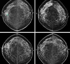 Average Breast Tumor Size Decreased Following Introduction of Screening