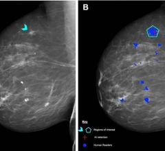 Using a standardized assessment, researchers in the UK compared the performance of a commercially available artificial intelligence (AI) algorithm with human readers of screening mammograms. 