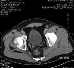 ultrasound systems, postoperative urinary retention, study