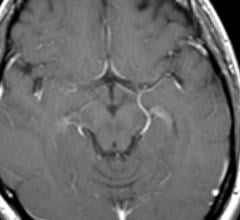 MRI, brain damage, heart disease protein, NT-proBNP, Radiology journal