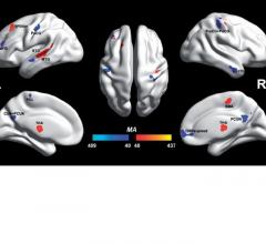 autism, fMRI, University of Warwick, voxels, BWAS