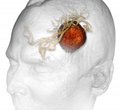 targeted radiosurgery, stereotactic radiosurgery, whole-brain radiation, brain tumor metastases, Cureus, University of Missouri School of Medicine study