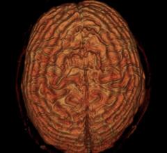 Post-Concussion Syndrome Radiology MRI