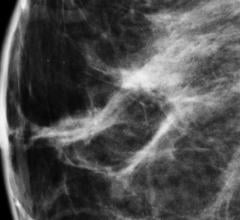 Dense breast tissue