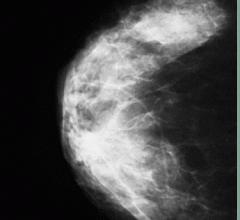 dense breast tissue