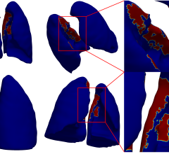 A new study led by researchers at Emory AI.Health, published in the Journal of Computers in Medicine and Biology, sheds light on the significant lung damage caused by severe COVID-19.