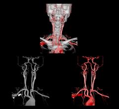 Aquilion Prime, radiation dose