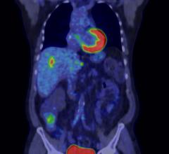 PET/CT helps bring personalized medicine within reach of practitioners. (Image courtesy of GE Healthcare)