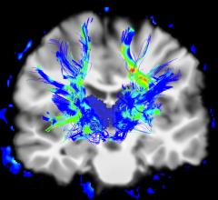 The structural and functional organization of the brain as shown on MRI can predict the progression of brain atrophy in patients with early-stage, mild Parkinson’s disease
