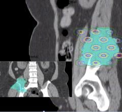 UT Southwestern, heavy ion radiation therapy, national center, first in U.S.