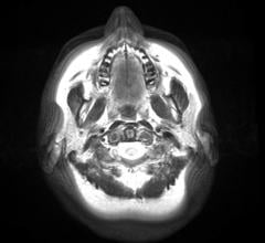 High-Strength MRI May Release Mercury from Amalgam Dental Fillings