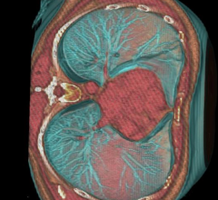 statins, heart scan, CT scan