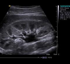 Portable Ultrasound Could Improve Kidney Disease Care for Former Prison Inmates