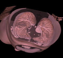 Minimal dose CT, chest X-Ray 