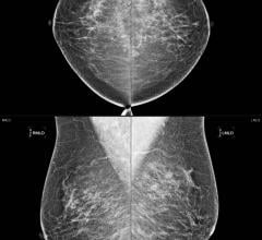 Middle East's first full-scale AI adoption for national screening marks Lunit's latest milestone amid rapid expansion of global cancer screening initiatives