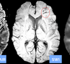 MRI systems, Clinical Trial/Study, Diffusion Tensor Imaging