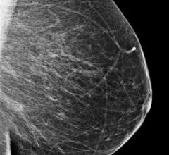 Bielefeld University Germany study, mammography screening, informed decisions