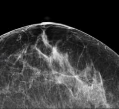 UC Davis study, digital mammography, safety, radiation risk