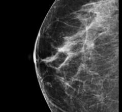 Mammography systems, women's health, RSNA 2014, breast density