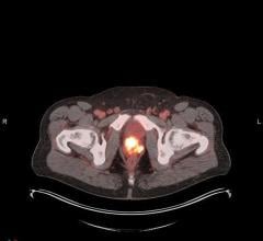 POSLUMA (flotufolastat F 18) PET/CT image showing uptake in the prostate gland, consistent with primary prostate cancer.